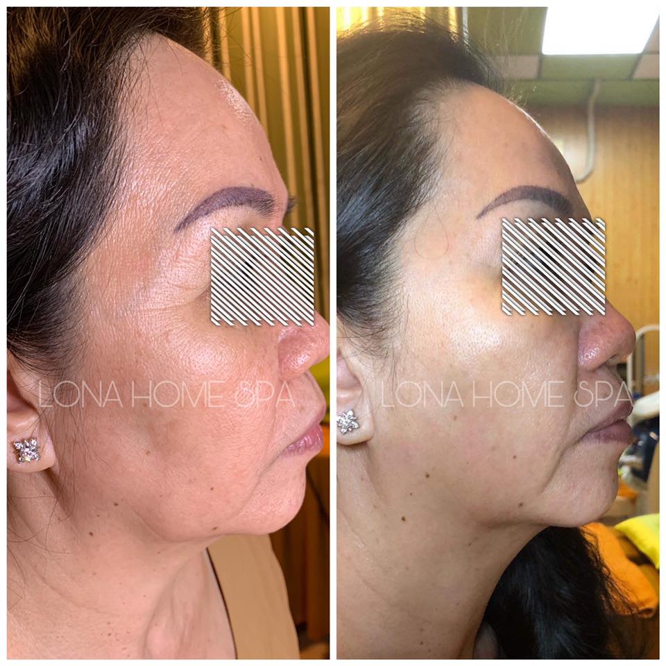 Kết quả da căng bóng, nếp nhăn ở đuói mắt giảm dần sau thời gian khách hàng nhà Lona sử dụng Retinol Skinceuticals chống lão hoá kết hợp với các sản phẩm khác được thiết kế riêng